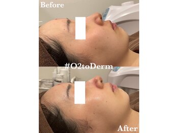 クレセント(crescent)/透明感だすなら白玉酸素セラピー