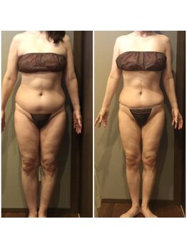 ムーン 高崎店(MOON)/セルゼロ痩身3ヶ月