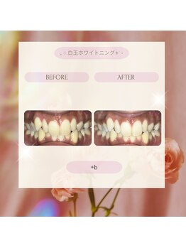 プラスビー 2号店(+b)/ホワイトニングビフォーアフター