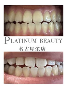 プラチナムビューティー 名古屋栄本店(PLATINUM BEAUTY)/お客様Before After