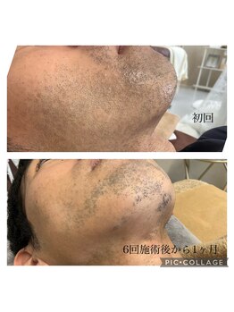 グラース(grace)/ヒゲ脱毛♪