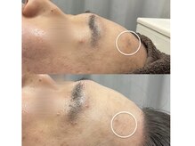 チェルト 鈴鹿店(CERTO)/REVIハーブピーリング