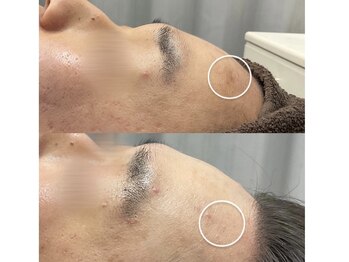 チェルト 鈴鹿店(CERTO)/REVIハーブピーリング