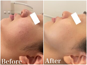 サロンドフェイス(Salon de Faith)/ハーブピーリング