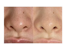 シェーン(Schon)/ピーリング《お鼻》