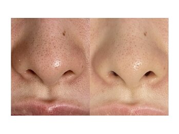 シェーン(Schon)/ピーリング《お鼻》