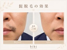 ビビ(bibi)/メンズヒゲ脱毛施術7回
