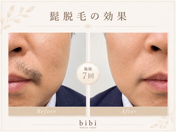 ビビ(bibi)/メンズヒゲ脱毛施術7回