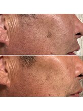 ルーメ(lume)/シミケア50代男性