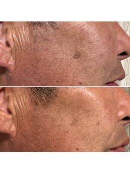 ルーメ(lume)/シミケア50代男性