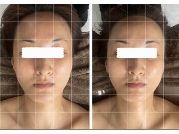 モア(moa)/小顔/フェイシャル/筋膜ケア