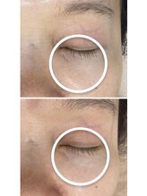 エステサロンパリス(Esthe Salon Paris)/目元の乾燥に悩まられいる方多数