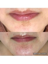 ラズ(Luz)/シミケア