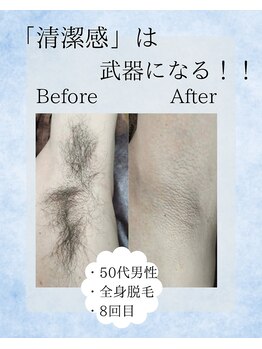 ポーベル(Peau belle)/脇脱毛　Before →After 