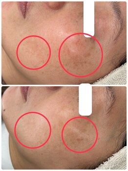 アンド ユー(and.yu)/40代/シミケア・美肌コース2回