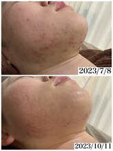 ホワイトアクア 岐阜店(WHITE AQUA)/ハーブピーリング/岐阜