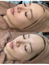 ララ(LALA)/ララピール姪浜/韓国肌管理/艶肌