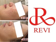 ルピナス(Lupinus)の雰囲気(肌質改善ハーブピーリングで美肌に!お得な回数券もあります。)