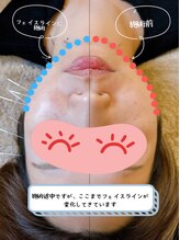 あんどら鍼灸接骨院/美顔鍼