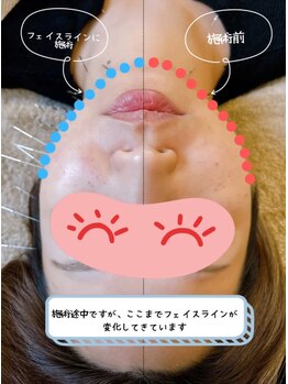 あんどら鍼灸接骨院/美顔鍼