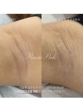 カリオン/ワキ、ヒップ下黒ずみ美白