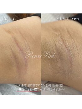 カリオン/ワキ、ヒップ下黒ずみ美白