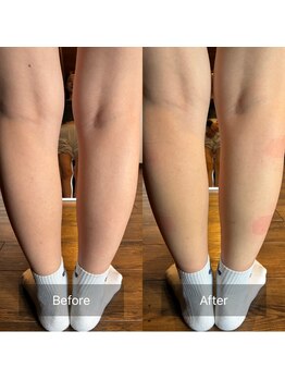 エムエイチセラピー(mhセラピー)/気になるO脚矯正