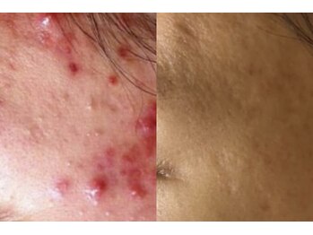 れふぇるん 足利店/30代 ニキビケア 施術8回