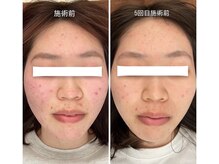 ライフ美容整体院 恵比寿(Life美容整体院)/ニキビケア