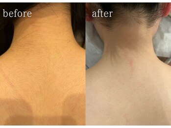 ニコリー(NICOLY)/うなじ脱毛