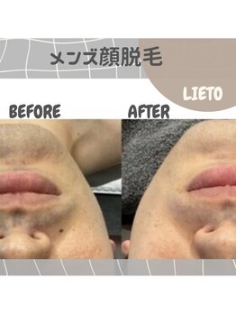 リエート(LIETO)/【メンズ様１番人気！顔脱毛】
