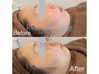 クレセント(crescent)/”インナードライ”なら水分爆弾