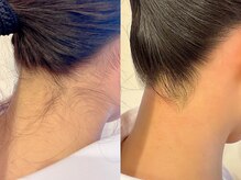 レネットサロン(Reinette Salon)/うなじダブル脱毛