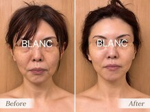 サロン ド ブラン アオヤマ(Salon de BLANC AOYAMA)の雰囲気（クリスティーナイラストリアス/目元、口元たるみ改善*しみ色むら）