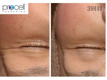 温(on)/プロセルセラピーズ肌質改善