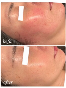 プレジール(Plaisir)/人気No. 1サーマ＋ララピ-ル+LDM