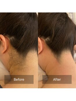 リンス(LINS)/BeforeAfter