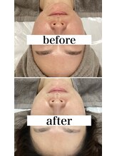 ホリシア 博多(HORISHIA)/ララピール/毛穴/ニキビケア