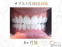 ホワイヤ セルフホワイトニング DBS神楽坂(Whi-Ya)/☆サブスク会員様☆納得の白さ☆