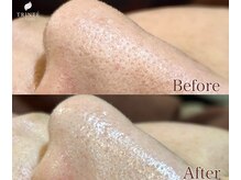 トリンテ バイ フェース(TRINTE by FAITH)の雰囲気（お肌に優しい3D毛穴洗浄で負担なく角栓除去。ツルツルな肌触り♪）