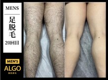 アルゴ 小倉守恒店(ALGO)/足脱毛