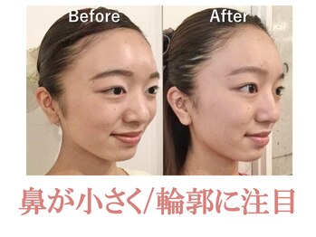 ラプリボヤージュ 藤沢店(Raplit)/隆鼻＋輪郭矯正40分10回コース
