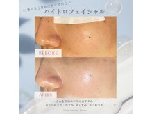 リアン(Lien)/【症例】ハイドロフェイシャル