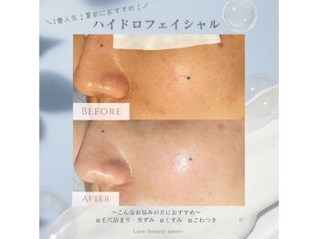 リアン(Lien)/【症例】ハイドロフェイシャル