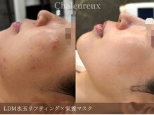 シャルル ストア 京都三条通(Chaleureux Store)の雰囲気（大人ニキビのお悩みから、素肌からの艶肌へ）