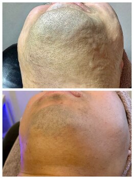 ジェンヌ(jenne.)/しぶとい髭もしっかり脱毛