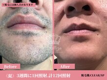 フェレザ 新潟(Felleza)/男性ビフォー＆アフター写真