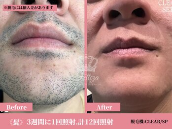 フェレザ 新潟(Felleza)/男性ビフォー&アフター写真