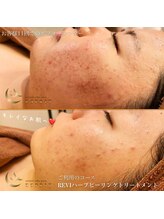 エスプリ 銀座店/ハーブピーリング銀座