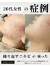 【本気の肌改善】ハーブピーリング全顔　¥12,000→¥9,800